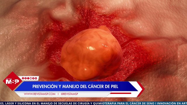 El melanoma puede estar en cualquier lugar: Prevención y manejo del cáncer de piel