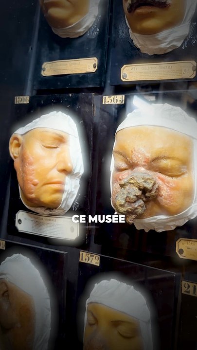 En 1867, un chirurgien de l’hôpital Saint‑Louis commande des moulages de peaux malades. Aujourd’hui, cette collection unique est exposée dans un musée pas comme les autres !🧑‍⚕️