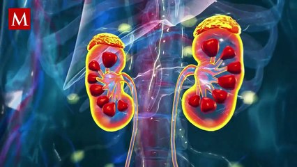 Ella arriesgó su vida y él la traicionó: donó un riñón y la dejó por otra