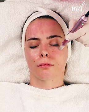 Dermapen microneedling for flawless skin vibes! ✨💆‍♀️