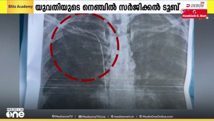 തിരുവനന്തപുരം ജനറൽ ആശുപത്രിയിൽ ചികിത്സ പിഴവ്: യുവതിയുടെ നെഞ്ചിൽ ഗൈഡ് വയർ കുടുങ്ങിയതായി പരാതി