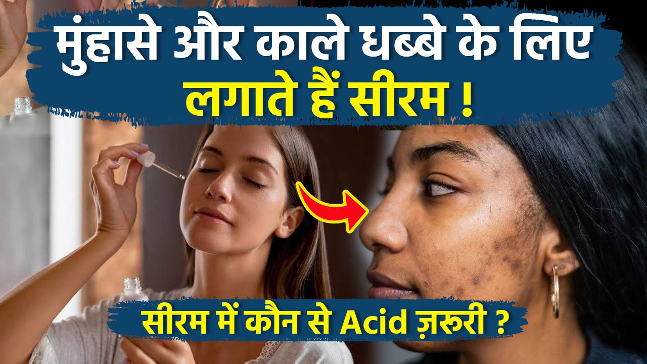 Serum For Acne and Dark Spots: मुंहासे निशान और काले धब्बे के लिए सीरम में कौन से एसिड होने चाहिए |