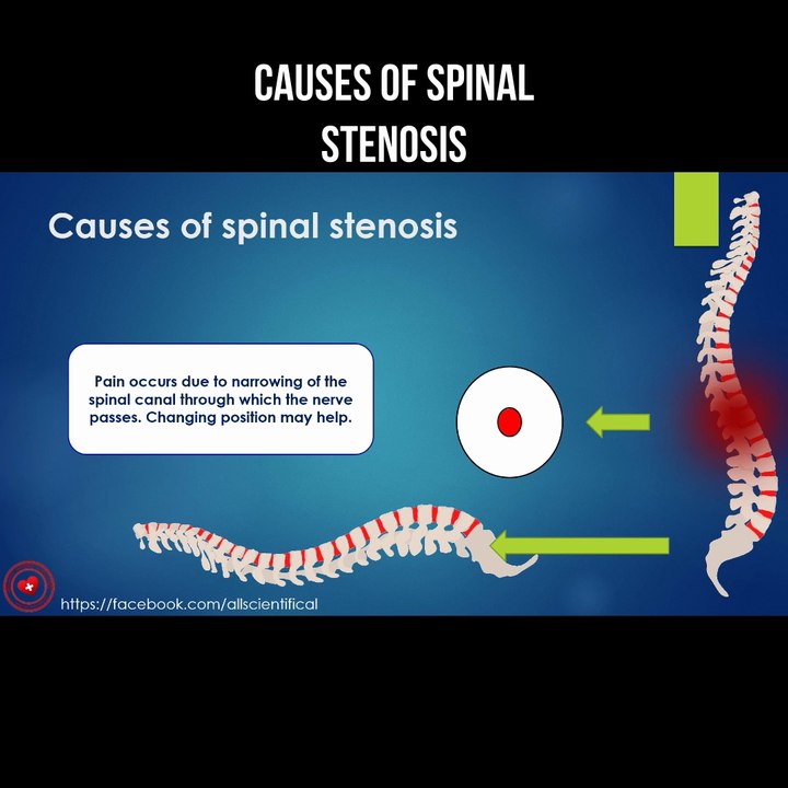 Causes of spinal stenosis