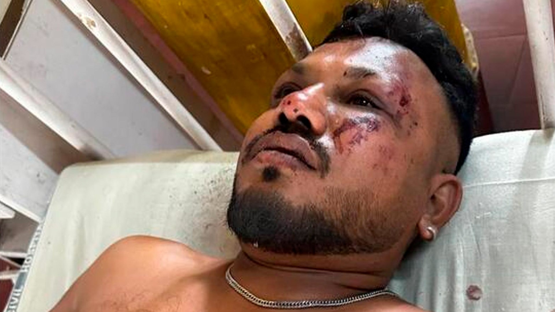 Ramesh, el milagro del superviviente del asiento 11A del avión estrellado en India