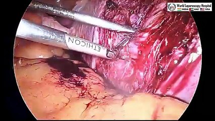20 CM Large Intramural Fibroid's Laparoscopic Myomectomy