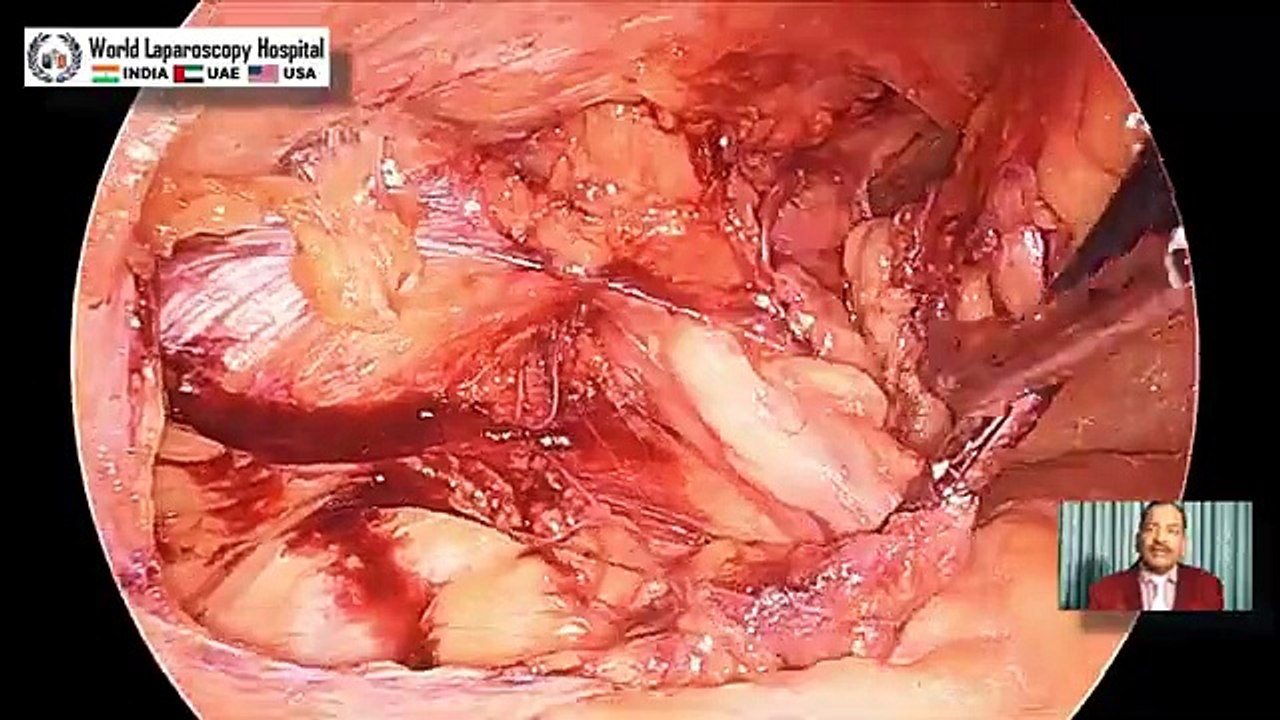 Advancing Surgical Care Minimally Invasive Hernia Repair using  Transabdominal Preperitoneal Repair