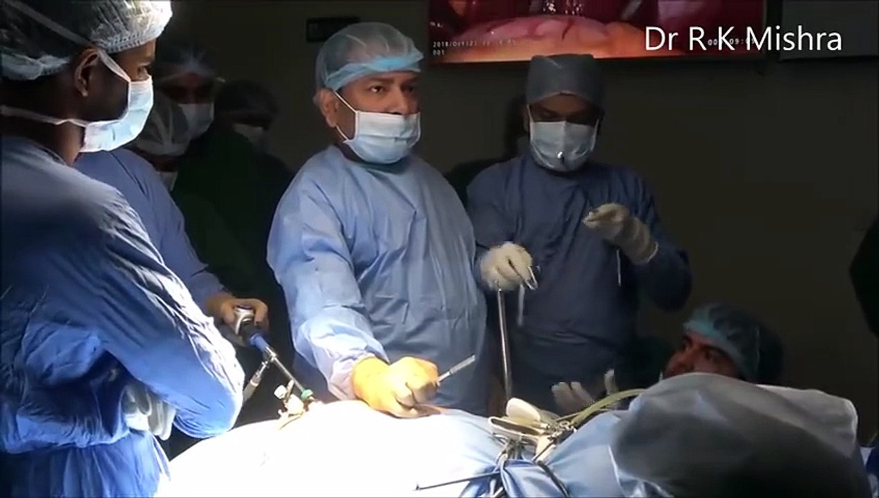 Bariatric Surgery Laparoscopic sleeve Gastrectomy Step by Step Video by Dr R K Mishra