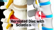 11 Best Exercises for Herniated Disc & Sciatica Pain Relief | Step-by-Step Guide
