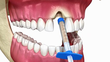 Socket Preservation (3D Animation)