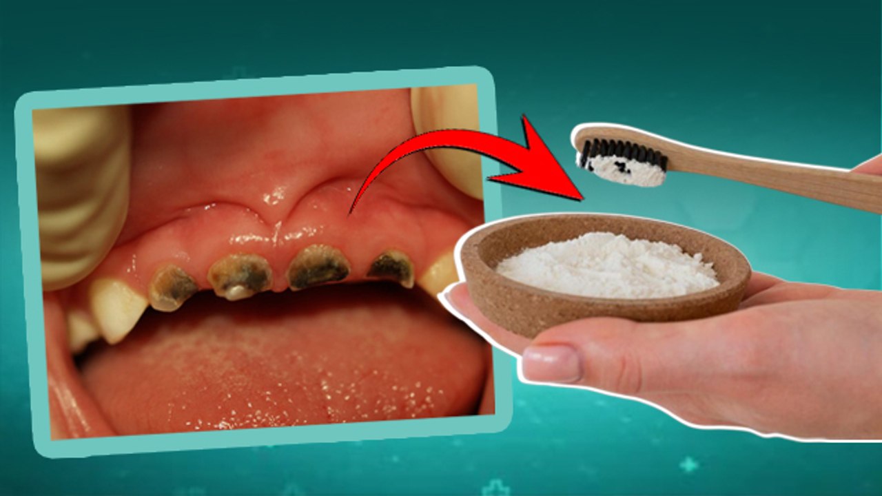 Remove Teeth Blackness:दांतों का कालापन कैसे दूर करें,Teeth Whitening Treatment | Boldsky