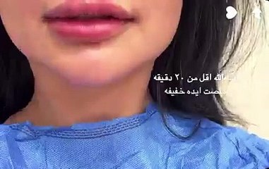ملكة كابلي بعد إزالة فيلر الشفاه
