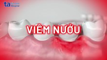 Viêm nướu là gì? Nguyên nhân, dấu hiệu và cách điều trị hiệu quả
