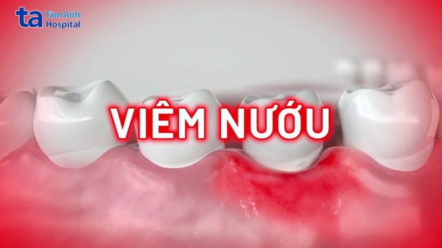 Viêm nướu là gì? Nguyên nhân, dấu hiệu và cách điều trị hiệu quả