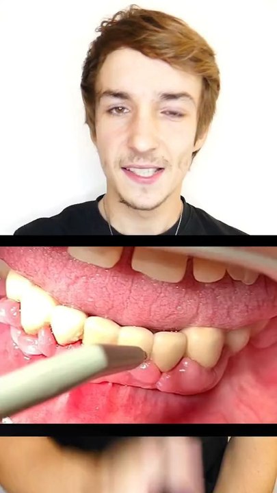 Comment perdre ses dents 🥲