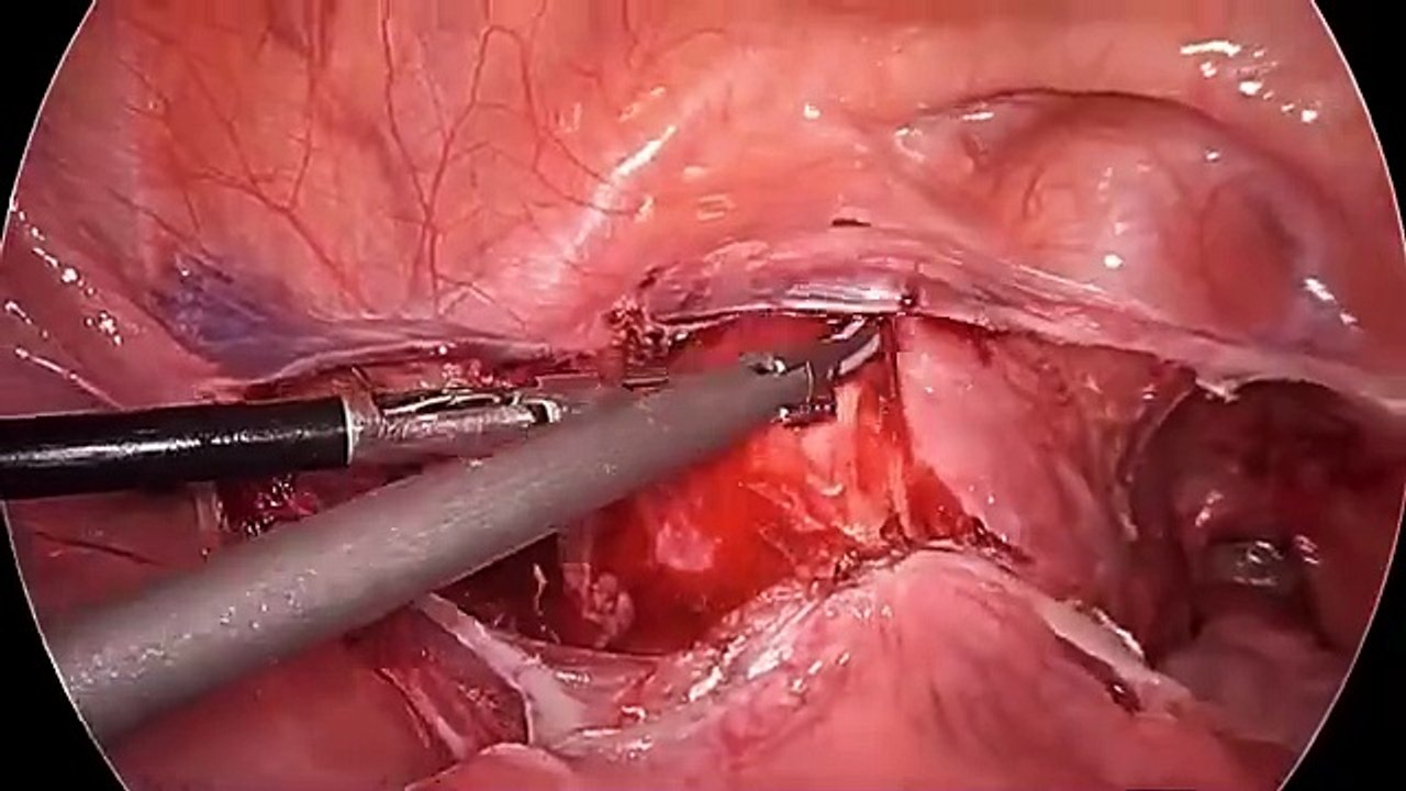 Total Laparoscopic Hysterectomy with Appendectomy | Advanced Gynecologic Surgery by Dr. R.K. Mishra