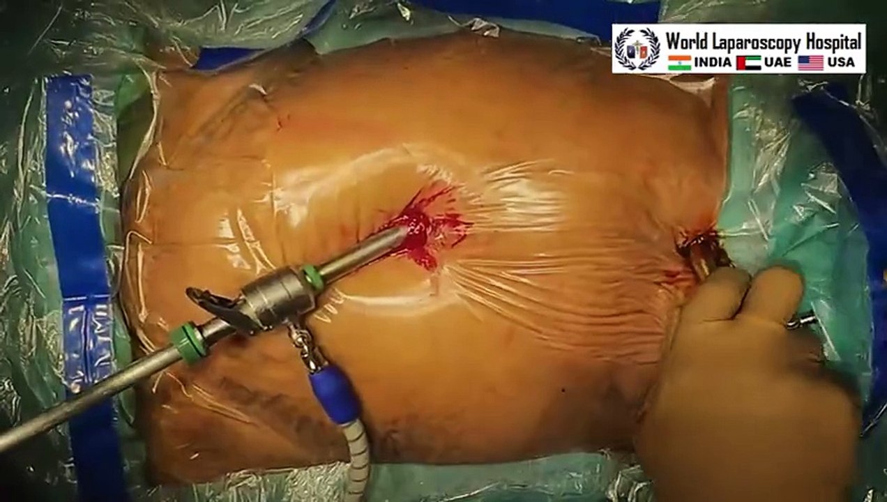 Port Efficiency - Laparoscopic Cholecystectomy, Appendectomy, and Tubal Ligation by same Port