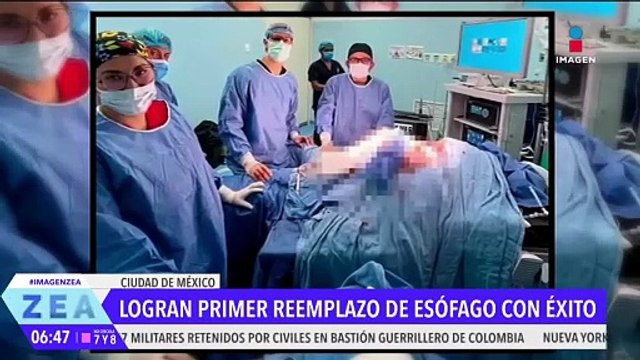 Hospital IMSS-Bienestar realiza con éxito cirugía de reemplazo total de esófago