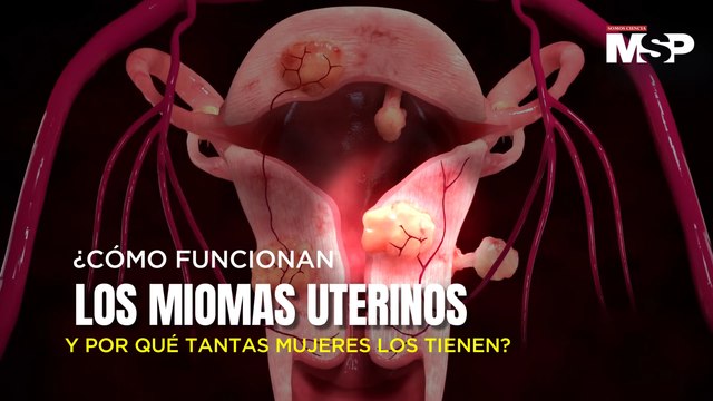 ¿Cómo funcionan los miomas uterinos y por qué tantas mujeres los tienen?