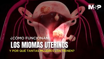 ¿Cómo funcionan los miomas uterinos y por qué tantas mujeres los tienen?