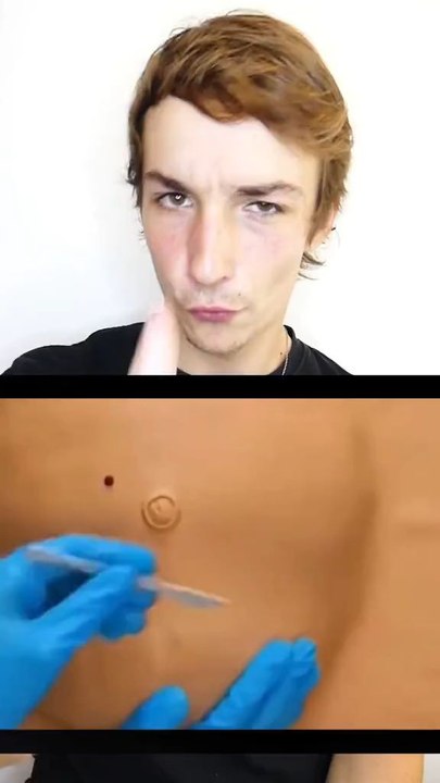 Comment se passe une césarienne ??