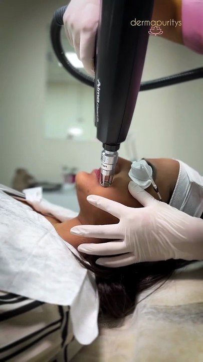 4D Clear Lift Treatment for Glowing Skin  Derma Puritys