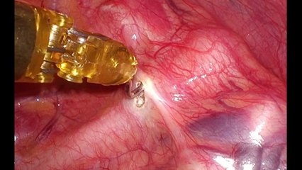 Robotic Bilateral T3 Sympathectomy for Palmar Hyperhidrosis: An Easy Minimally Invasive Solution