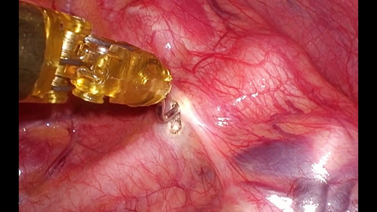 Robotic Bilateral T3 Sympathectomy for Palmar Hyperhidrosis: An Easy Minimally Invasive Solution