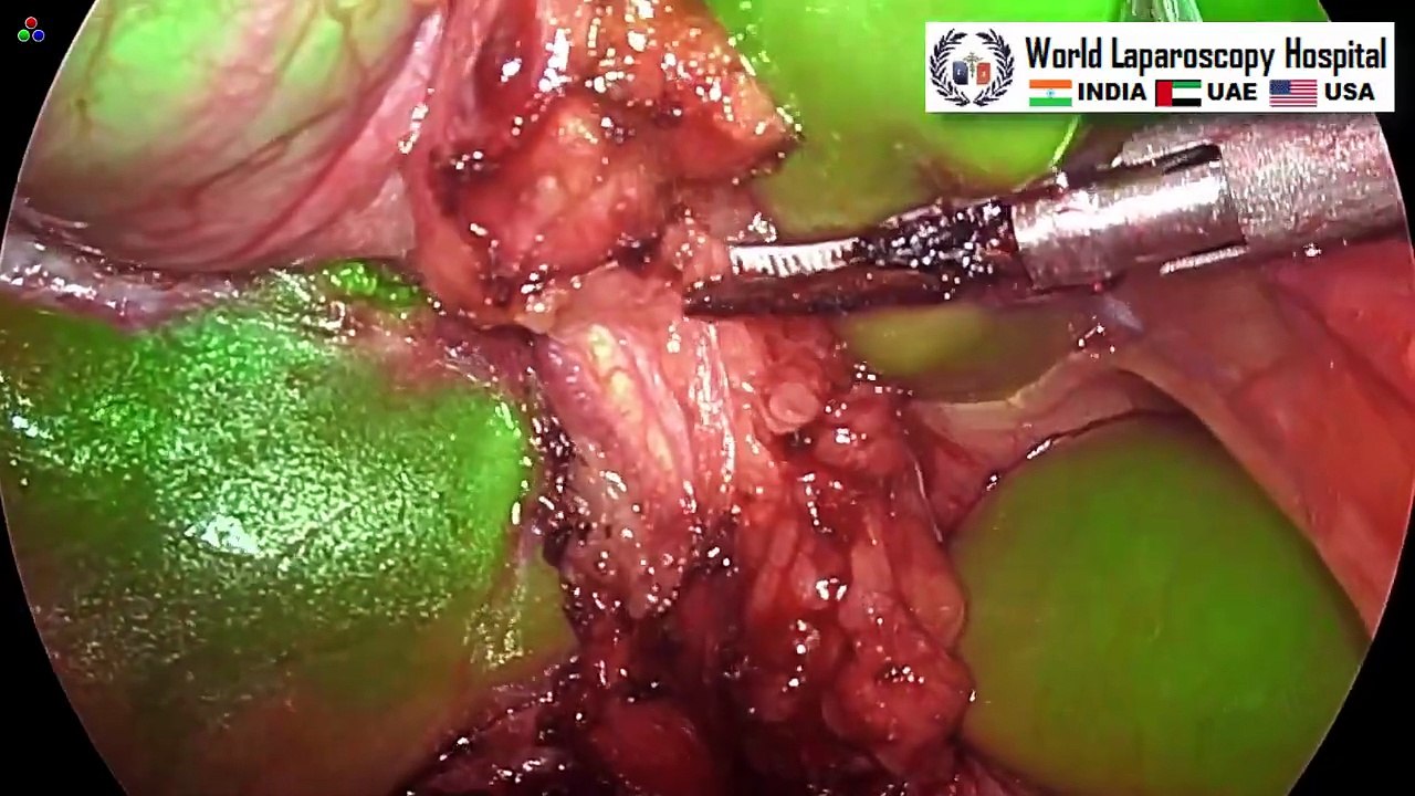 Two-Port Laparoscopic Cholecystectomy Using Mini Alligator Instrument