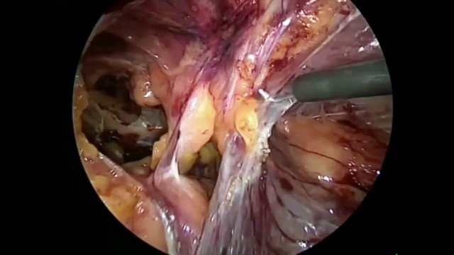 Laparoscopic Transabdominal Preperitoneal (TAPP) Hernia Repair by Suturing: A Comprehensive Approach