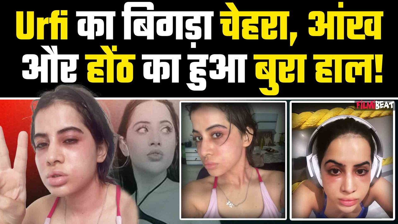 Urfi aka Uorfi Javed का बिगड़ गया पूरा चेहरा, जानें किस  चक्कर से हुआ Actress का ये हाल| FilmiBeat