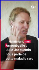 Julie Jacquemin, atteinte d'acromégalie, nous parle de cette maladie rare
