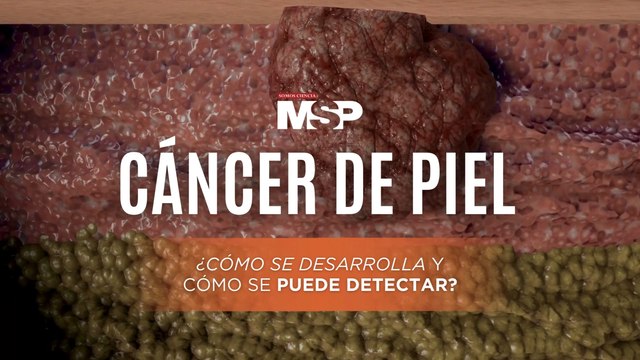 Cáncer de piel - Cómo se desarrolla y cómo se puede detectar