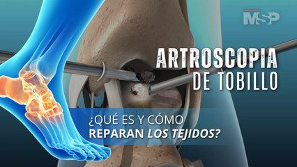 Artroscopia de tobillo - Qué es y cómo reparan los tejidos