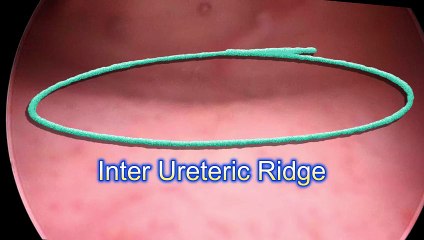 How to use Indocyanine green for localization of ureter - Dr. R. K. Mishra