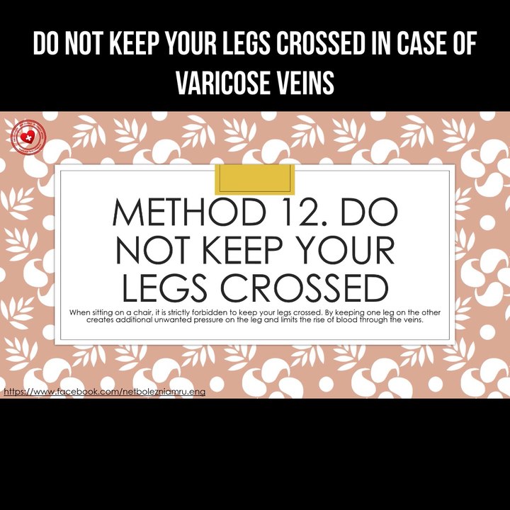 Do not keep your legs crossed in case of varicose veins