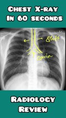Chest X-ray interpretation