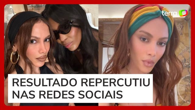 Anitta revela ‘novo rosto’ após procedimento estético, e fãs reagem: ‘Outra pessoa’