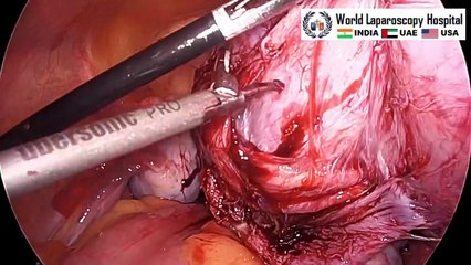 Laparoscopic Myomectomy Surgery for Large, Soft Myoma due to Gonadotropin-Releasing Hormone Therapy