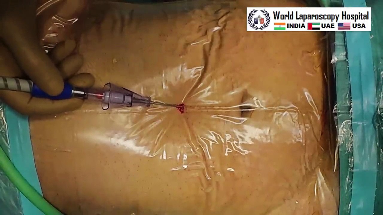Laparoscopic Dermoid Cyst Removal Surgery | Minimally Invasive Ovarian Cystectomy at WLH