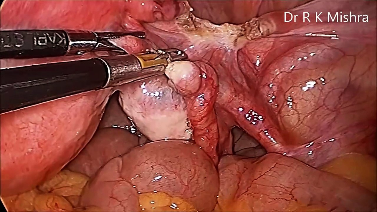 Hysterectomy by Laparoscopic Technique