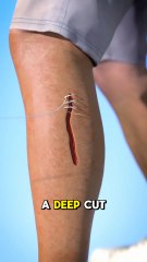 This Is How Stitched Wounds Heal