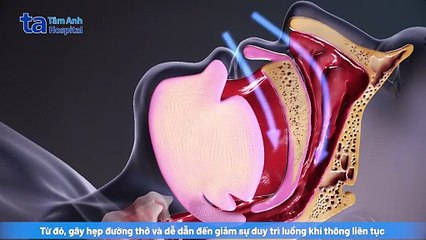 Ngưng thở khi ngủ do béo phì: Mối nguy bị xem nhẹ | BVĐK Tâm Anh