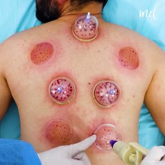 Cupping therapy & algae face mask! 💆🧘