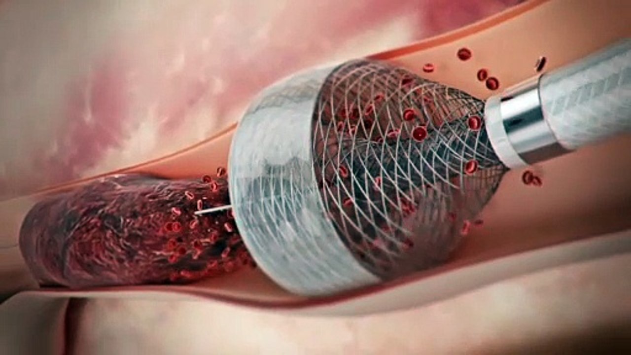 Funnel Vascular Animation
