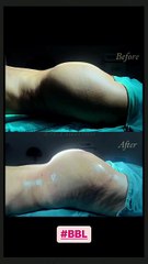 تكبير المؤخرة