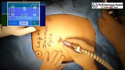 Laparoscopic Surgery for Left Ovarian Dermoid Cyst