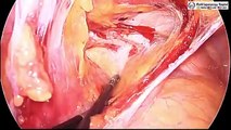 Laparoscopic Management of Suprapubic Incisional  Hernia