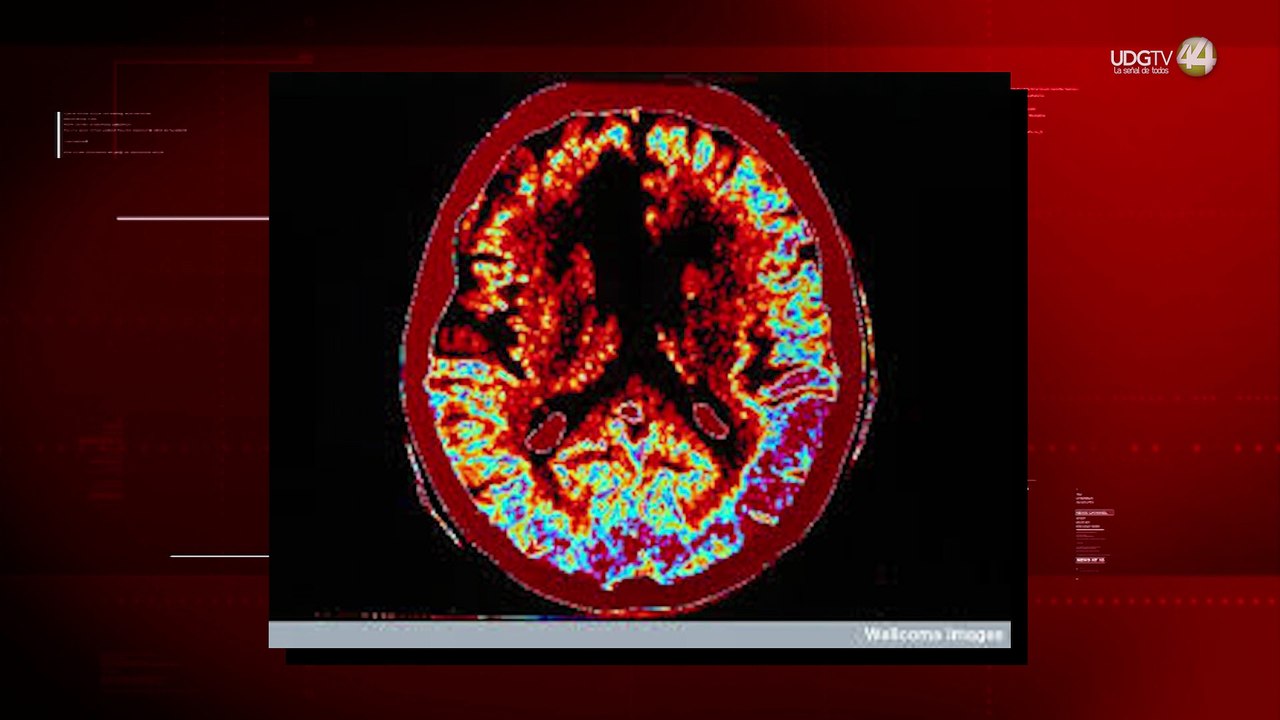 Médicos alertan sobre aumento de infartos cerebrales en México; urge capacitación