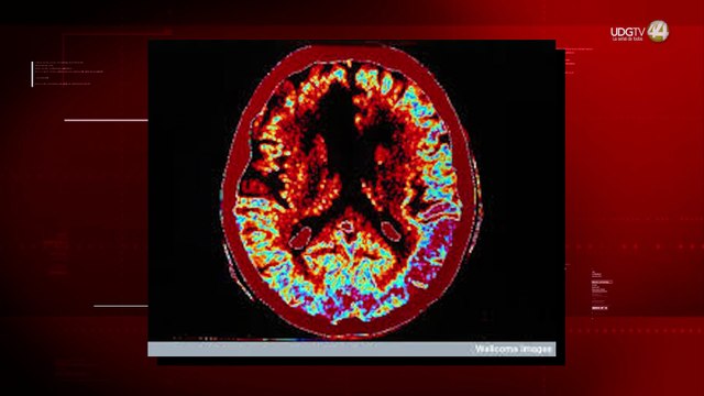 Médicos alertan sobre aumento de infartos cerebrales en México; urge capacitación