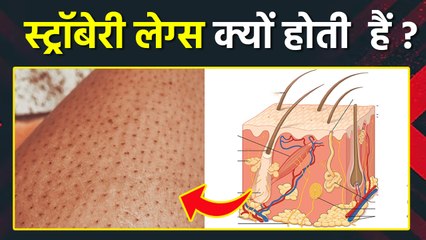 Strawberry Legs क्यों होते हैं, Causes, Treatment In Hindi... | Boldsky